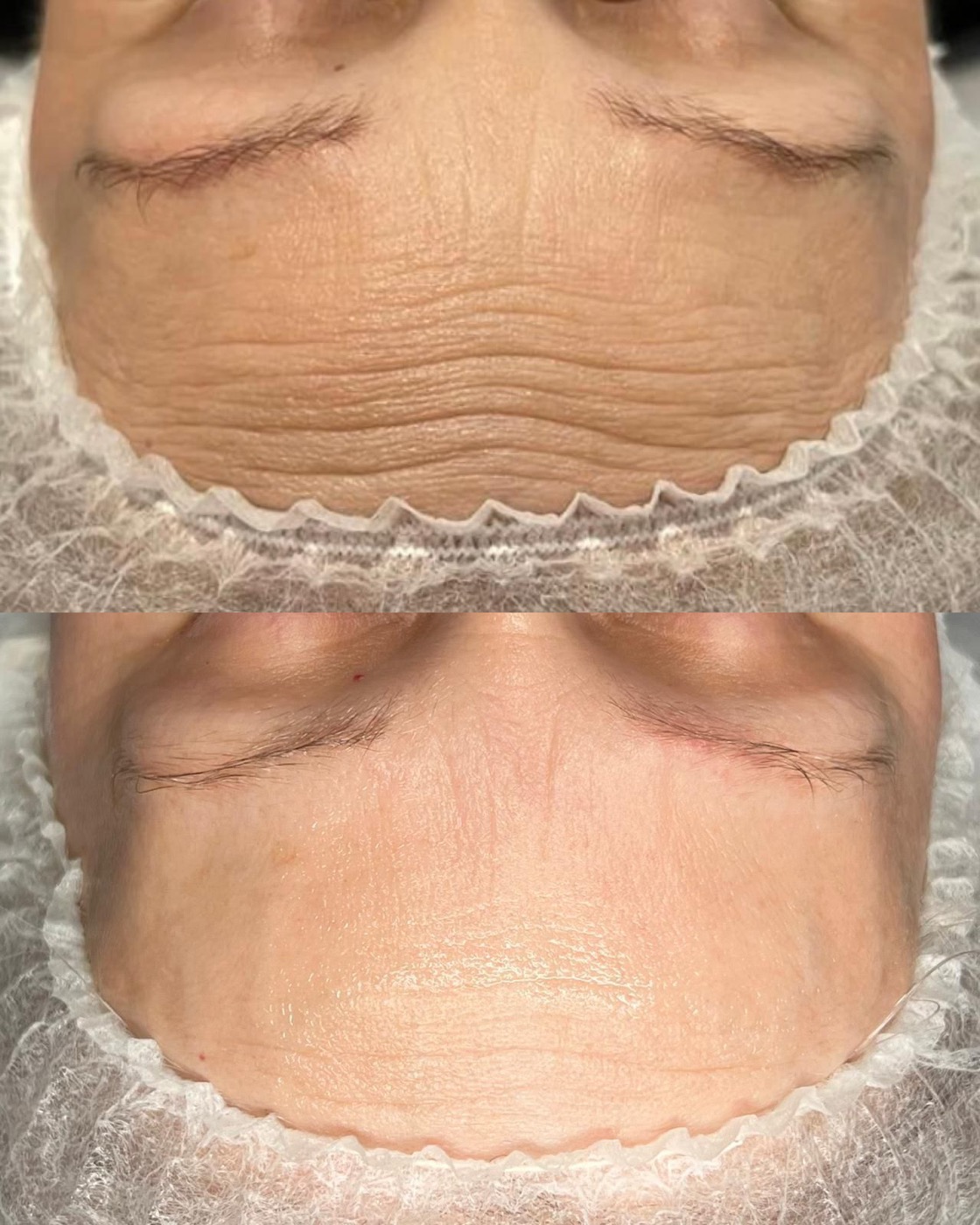 Efekty zabiegów anti-age w Szwajcer Atelier